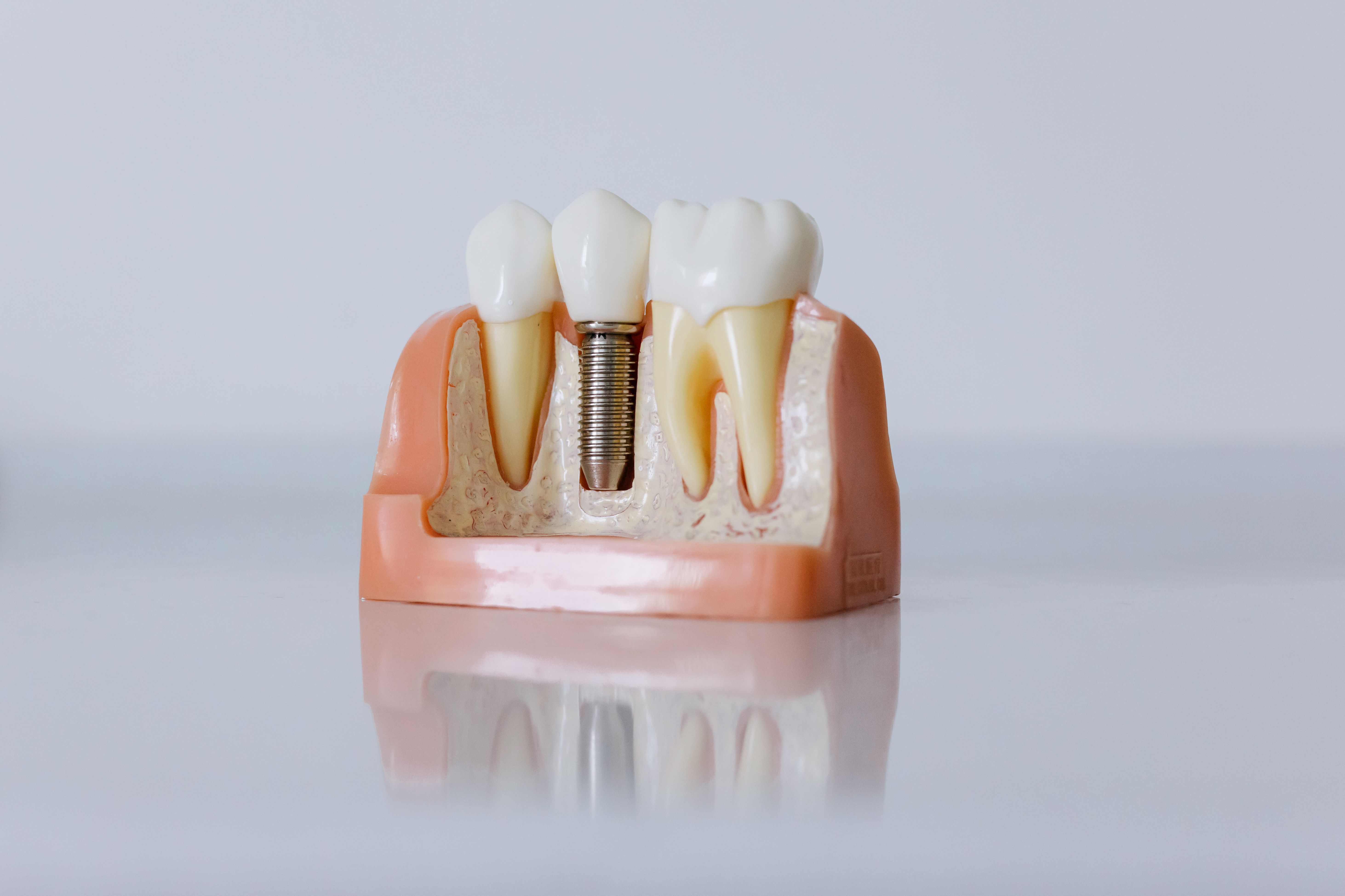 Dental Implants Explained: Procedure, Types, Benefits, Recovery & Oral Health Guide